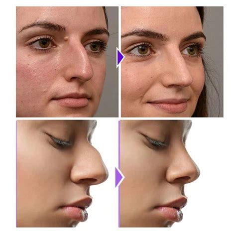 nose shaper results|The Truth On Nose Shaping Devices .